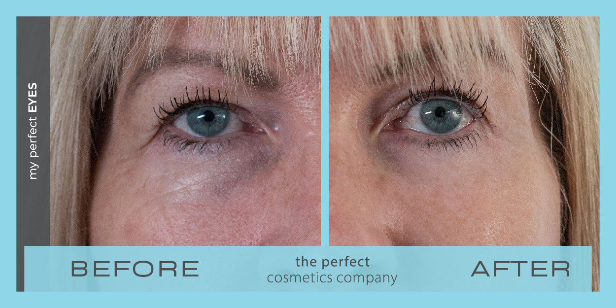 My Perfect Eyes before and after image showing reduced under-eye bags and dark circles, providing non-surgical results similar to blepharoplasty. Instant eye bag and dark circle treatment.