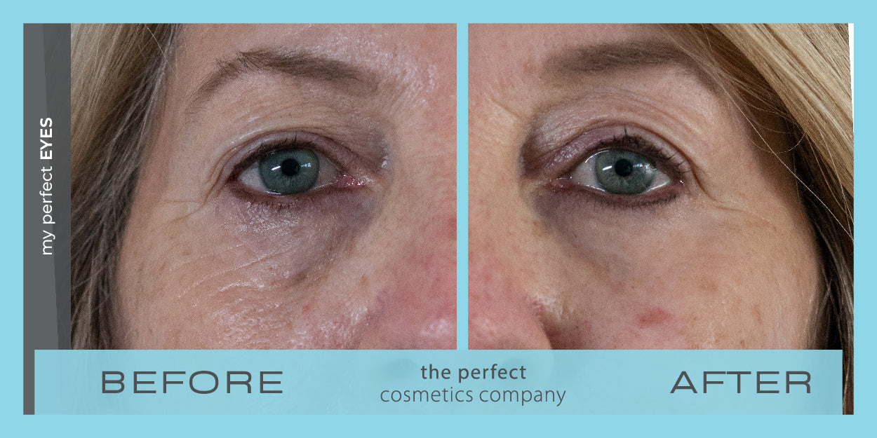 My Perfect Eyes before and after image showing reduced under-eye bags and dark circles, providing non-surgical results similar to blepharoplasty. Instant eye bag and dark circle treatment.