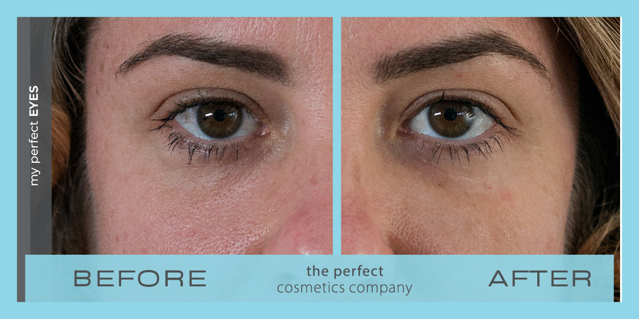 My Perfect Eyes before and after image showing reduced under-eye bags and dark circles, providing non-surgical results similar to blepharoplasty. Instant eye bag and dark circle treatment.