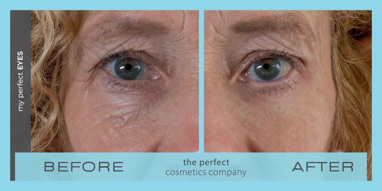 My Perfect Eyes before and after image showing reduced under-eye bags and dark circles, providing non-surgical results similar to blepharoplasty. Instant eye bag and dark circle treatment.