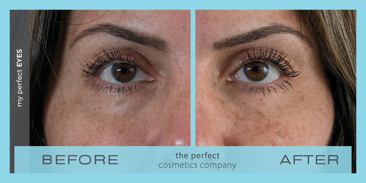 My Perfect Eyes before and after image showing reduced under-eye bags and dark circles, providing non-surgical results similar to blepharoplasty. Instant eye bag and dark circle treatment.