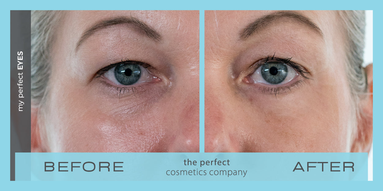My Perfect Eyes before and after image showing reduced under-eye bags and dark circles, providing non-surgical results similar to blepharoplasty. Instant eye bag and dark circle treatment.